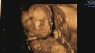 19 week ultrasound Its a girl Includes 3d4d scan [upl. by Aivart]