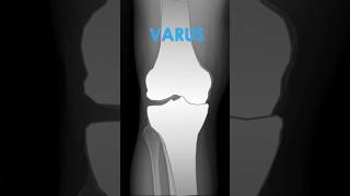 Varus  Valgus Deformities of the Knee on XRay kneepain radiology anatomy [upl. by Huei647]