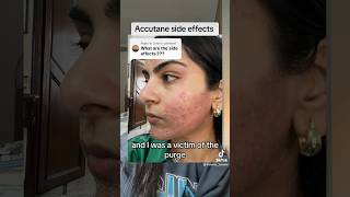 Accutane side effects accutane acne [upl. by Ardeen506]