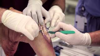 Patellar Tendon Graft [upl. by Pavier]