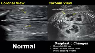 Fetal Kidneys Ultrasound Normal VS Abnormal Image Appearances  Kidney Abnormalities USG  ObGynae [upl. by Yevoc]