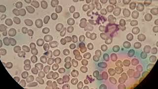 Blood film smear shows normochromic normocytic crenated red cells and aggregation of platelets [upl. by Drofnas100]