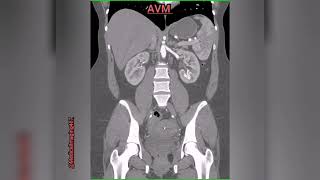 AVMArteriovenous malformations in left kidney [upl. by Adiv]