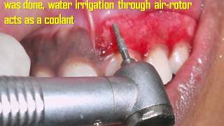 Gingival Depigmentation Procedure Using Diamond Bur Case By Dr Akash Akinwar [upl. by Hgieliak986]