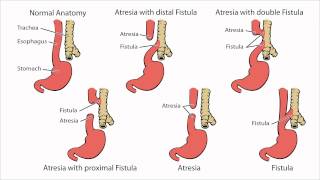 Esophageal Atresia  What is Esophageal Atresia [upl. by Decato]