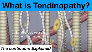 The Tendinopathy Tendon Tendonitis Continuum Theory Explained [upl. by Aromat]