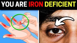 10 ALARMING Signs You Have An Iron Deficiency Anemia [upl. by Anema]