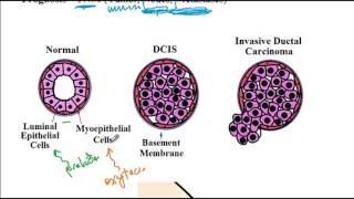 Breast disorders fibrocystic disease mammary duct ectasia USMLE Step 1 USMLE ACE [upl. by Gaskill]