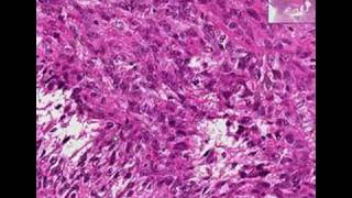 Histopathology Uterus Leiomyosarcoma [upl. by Nnayram115]