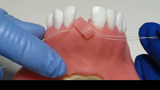 positioning suture and CT grafting via tunneling technique [upl. by Amsirp]