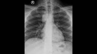 Mediastinal Lymphadenopathy cTBNA  Dr Rajdeep Dhandhukiya [upl. by Ecirahc787]