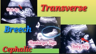 Transverse Breech amp Cephalic Baby In Uterus Genderreveal  Anterior Posterior Placenta Baby Gender [upl. by Auahsoj100]