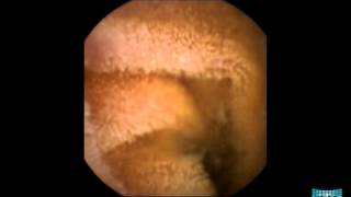 Inflammatory Lesions in the Small Bowel [upl. by Guod733]