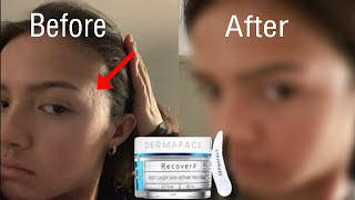 I tried DermaFacs RecoverX on my pitted acne scars for 3 months and here are my results [upl. by Lipsey]