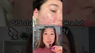 acne transformation through accutane check out my Accutane vid for more info like side effects [upl. by Hinze]