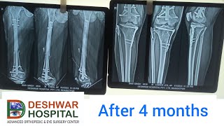 FEMUR amp TIBIA FRACTURE RECOVERY BY ADVANCE TITANIUM NAIL MRFN femurfracturerecovery ligamentinjury [upl. by Clarkson817]