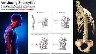 Ankylosing Spondylitis  Mechanism Risk Factors amp SignsSymptoms [upl. by Inod]