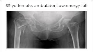 Fixation of intertrochanteric femur fractures SHS vs nail  Debate [upl. by Ococ425]