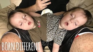 Conjoined Twins Are A Medical Miracle  BORN DIFFERENT [upl. by Acimad]