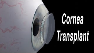 Cornea Transplant Penetrating Keratoplasty [upl. by Atelra]