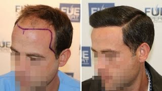 FUE Hair Transplant 3958 grafts in NWClass lVA Dr Juan Couto  FUEXPERT CLINIC  Madrid Spain [upl. by Ikram]