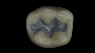 class 1 amalgam restoration for lower 6 [upl. by Watkin]