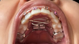 Braces Vlog Getting My Palatal Expander Appliance  Tongue Crib [upl. by Missi622]