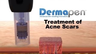 MicroNeedling for Acne Scars  Dermapen® Treatment [upl. by Burd]