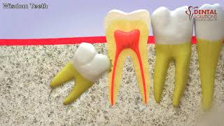 All you need to know about the eruption of a wisdom tooth [upl. by Loresz741]