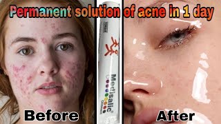 Medisalic cream चेहरे की काली परत उतारे Safe or not  Permanent solution of pimples  Ashu Rana [upl. by Jaco]