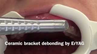 Ceramic bracket debonding by ErYAG [upl. by Urissa700]