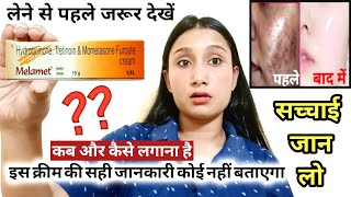 Melamet CreamUsesSide effectsReviewMelamet Cream Remove PigmentationMelasma How to use in Hindi [upl. by Amund]