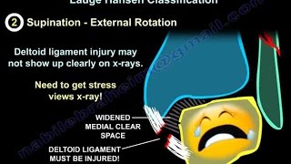 Ankle Fractures  Everything You Need To Know  Dr Nabil Ebraheim [upl. by Ibbison]