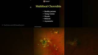 Multifocal Choroiditis ophthalmology optometry [upl. by Rani659]