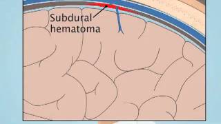 Understanding Subdural Hematoma [upl. by Carilyn539]