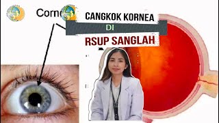 CANGKOK KORNEA DI RSUP SANGLAH [upl. by Drud]