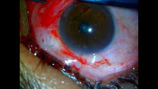 Pterygium Surgery with conjunctival autograft without glue [upl. by Adrianne965]