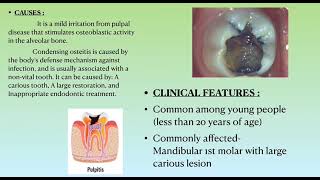 condensing osteitis [upl. by Silverstein807]