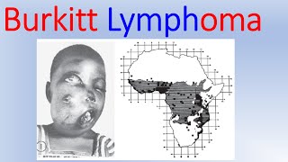 Burkitt lymphoma overview [upl. by Iny206]