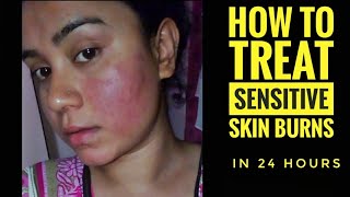 My SENSITIVE SKIN BURNS amp ALLERGIES Live Treatment Sensitive skin home remedies  Lovebeautybee [upl. by Bertine]