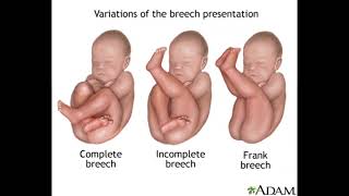 Whats Really Happening During a Breech Presentation [upl. by Suiluj]