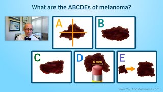 What are the signs and symptoms of melanoma [upl. by Charmaine598]