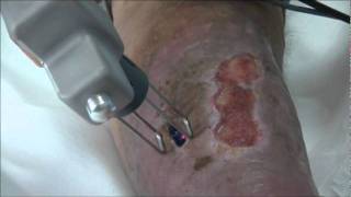 Phlebology  Debridement and Photobiostimulation of Venous Ulcer  Ulcera LASEmaR [upl. by Jorgensen571]