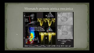 Prótesis valvulares segunda parte [upl. by Peltz]