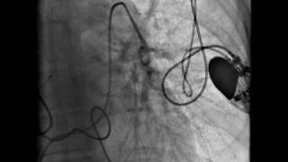 Pulmonary embolism Part 1 [upl. by Birdella]