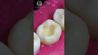 Repairing Dental Caries toothrestoration shorts [upl. by Yrekcaz]