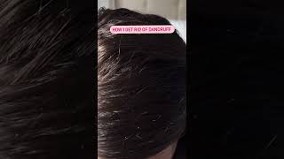 How I get rid of dandruff using a scalp massage brush [upl. by Garges]