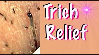 Trich Relief Video  Help for Trichotillomania [upl. by Laurin382]