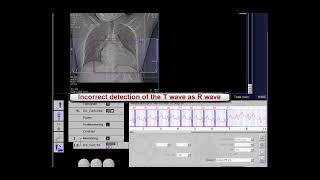 CT ECG Editing For 2 [upl. by Entruoc]