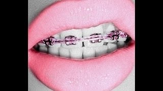 Confidence With Braces D [upl. by Ia]